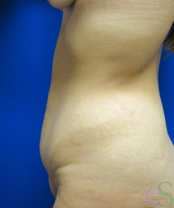 Tummy Tuck Patient 61 before photo. Individual results may vary.
