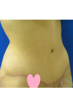Tummy Tuck Patient 61 after photo. Individual results may vary.