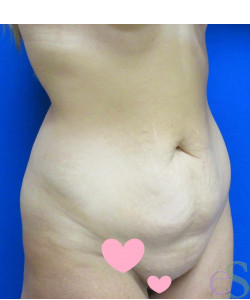 Tummy Tuck Patient 61 before photo. Individual results may vary.