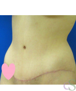 Tummy Tuck Patient 61 after photo. Individual results may vary.