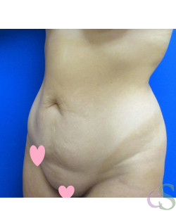 Tummy Tuck Patient 61 before photo. Individual results may vary.