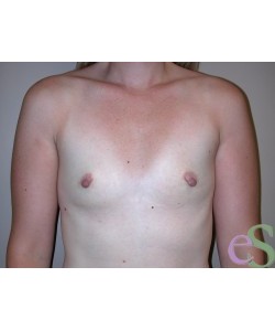 Breast Augmentation Patient 21 before photo. Individual results may vary.