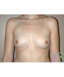 Breast Augmentation Patient 36 before photo. Individual results may vary.