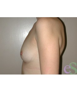 Breast Augmentation Patient 36 before photo. Individual results may vary.